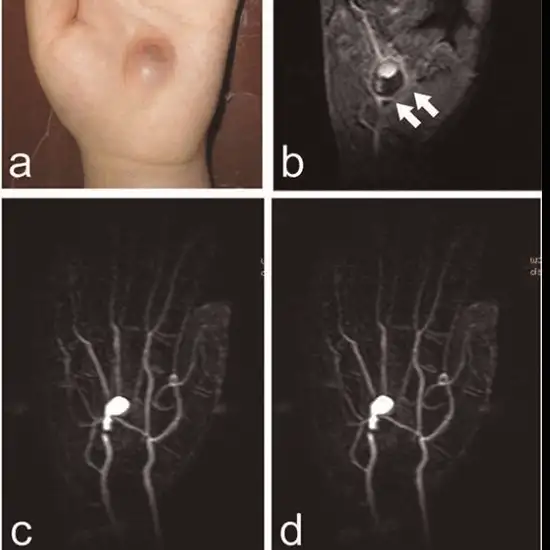 mr angiography palm test